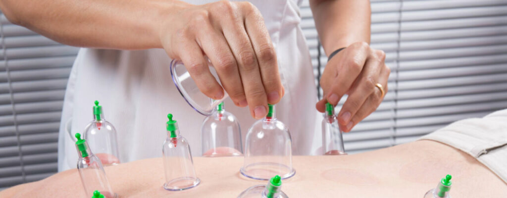 Relieving Muscle Pain with Cupping